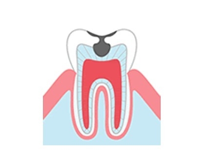 神経まで進んだむし歯（C3）