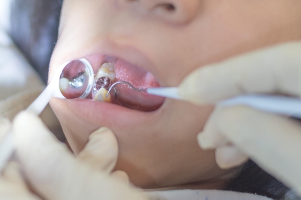 銀歯治療のデメリット